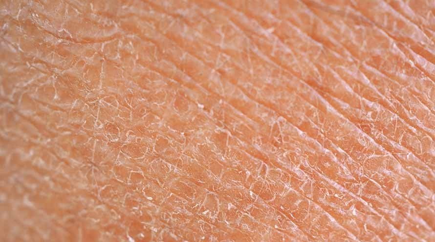 Dry Skin
