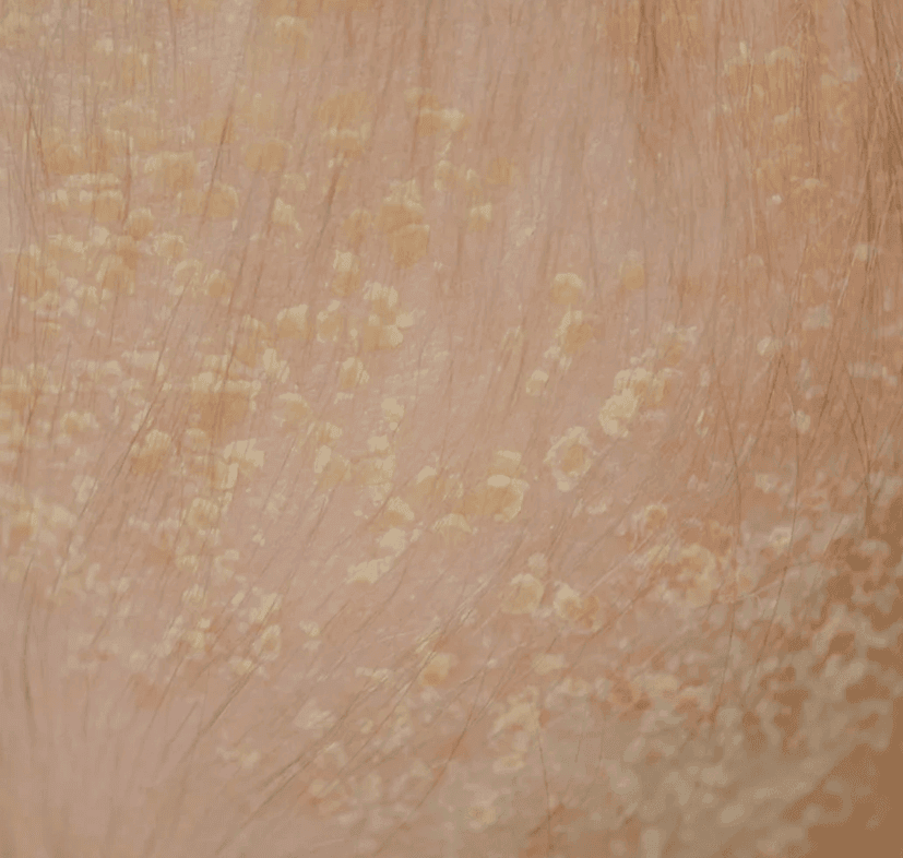 Seborrheic Dermatitis