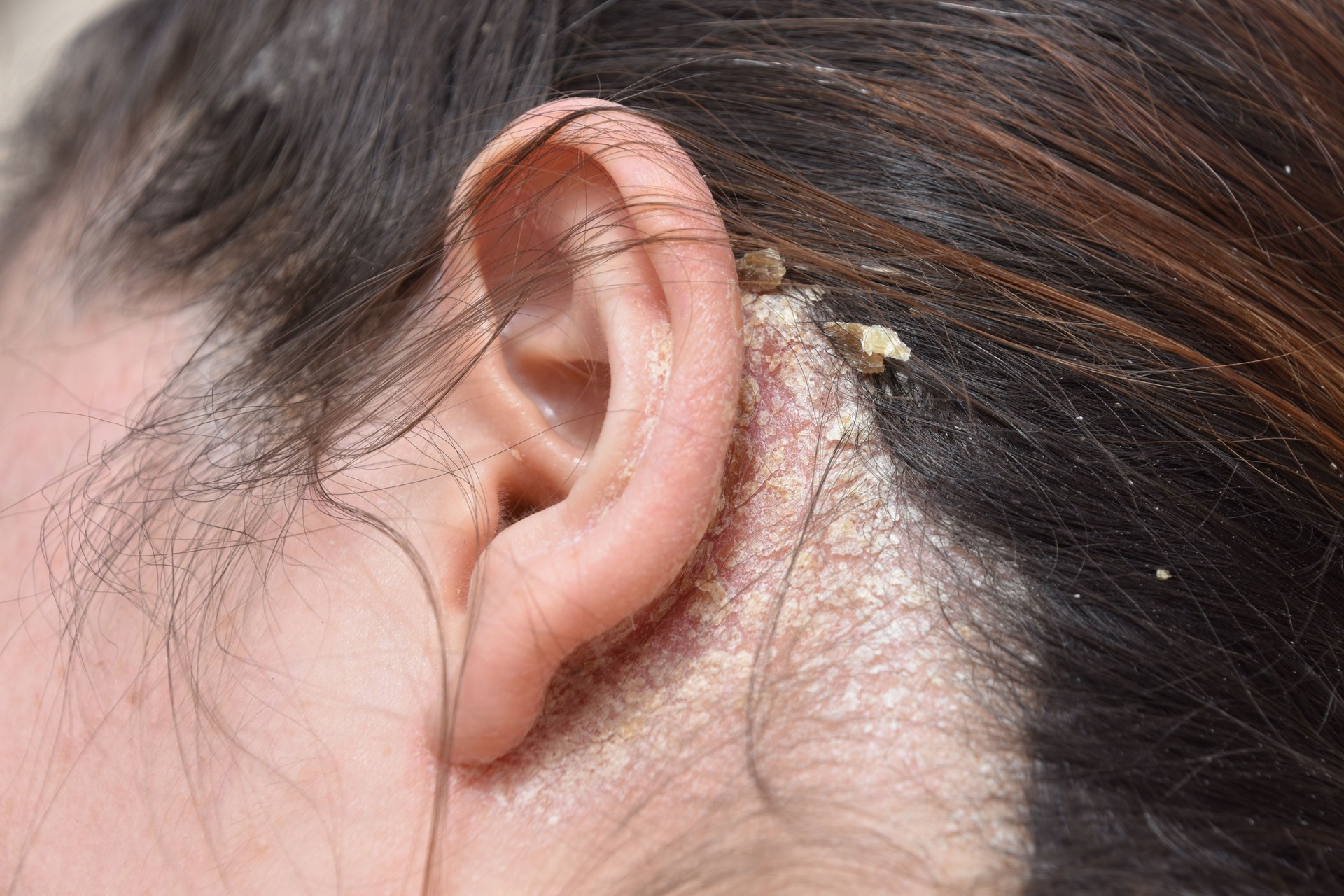 woman with serious problem of dandruff