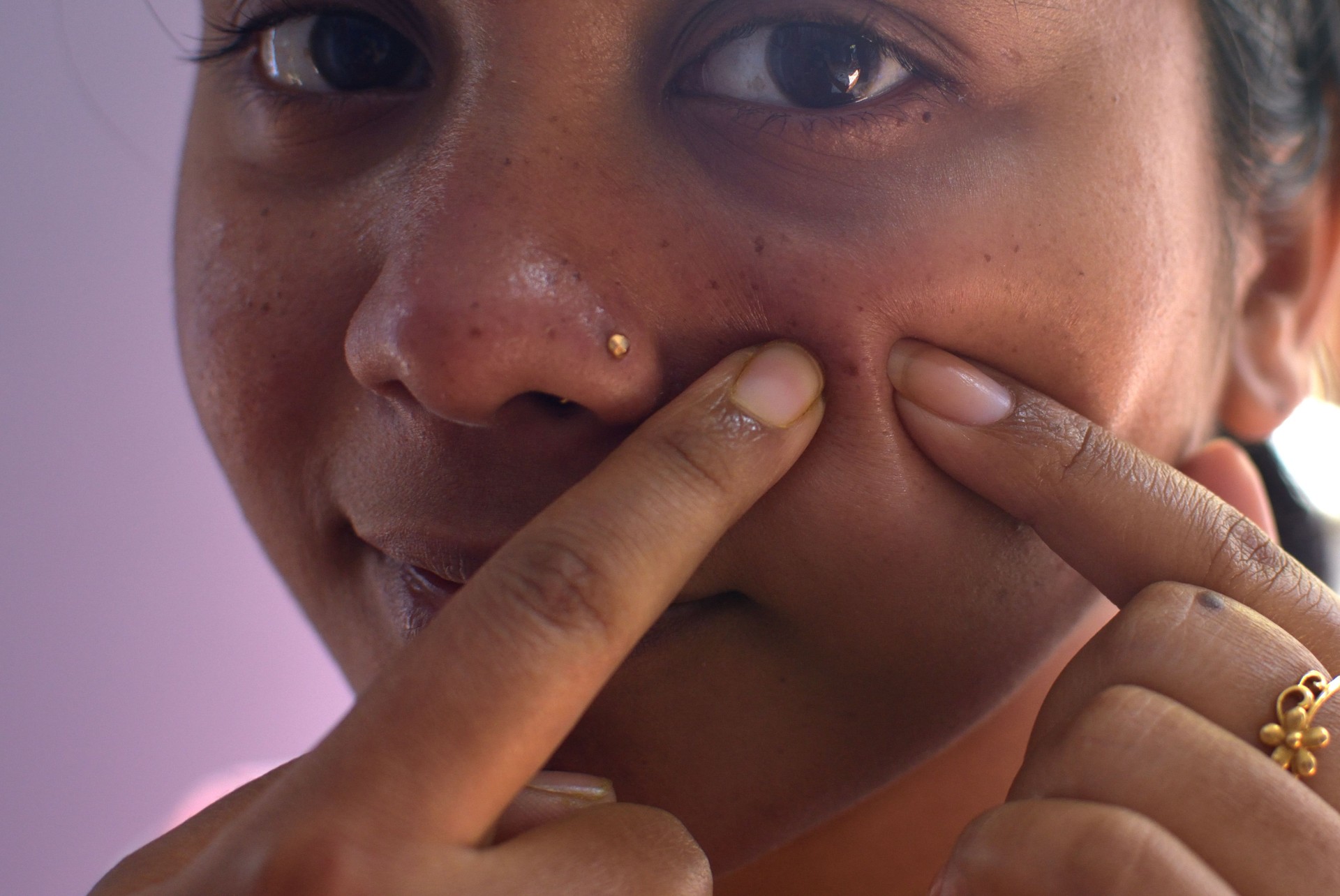 Young woman squeezing pimple on her cheek close up shot.