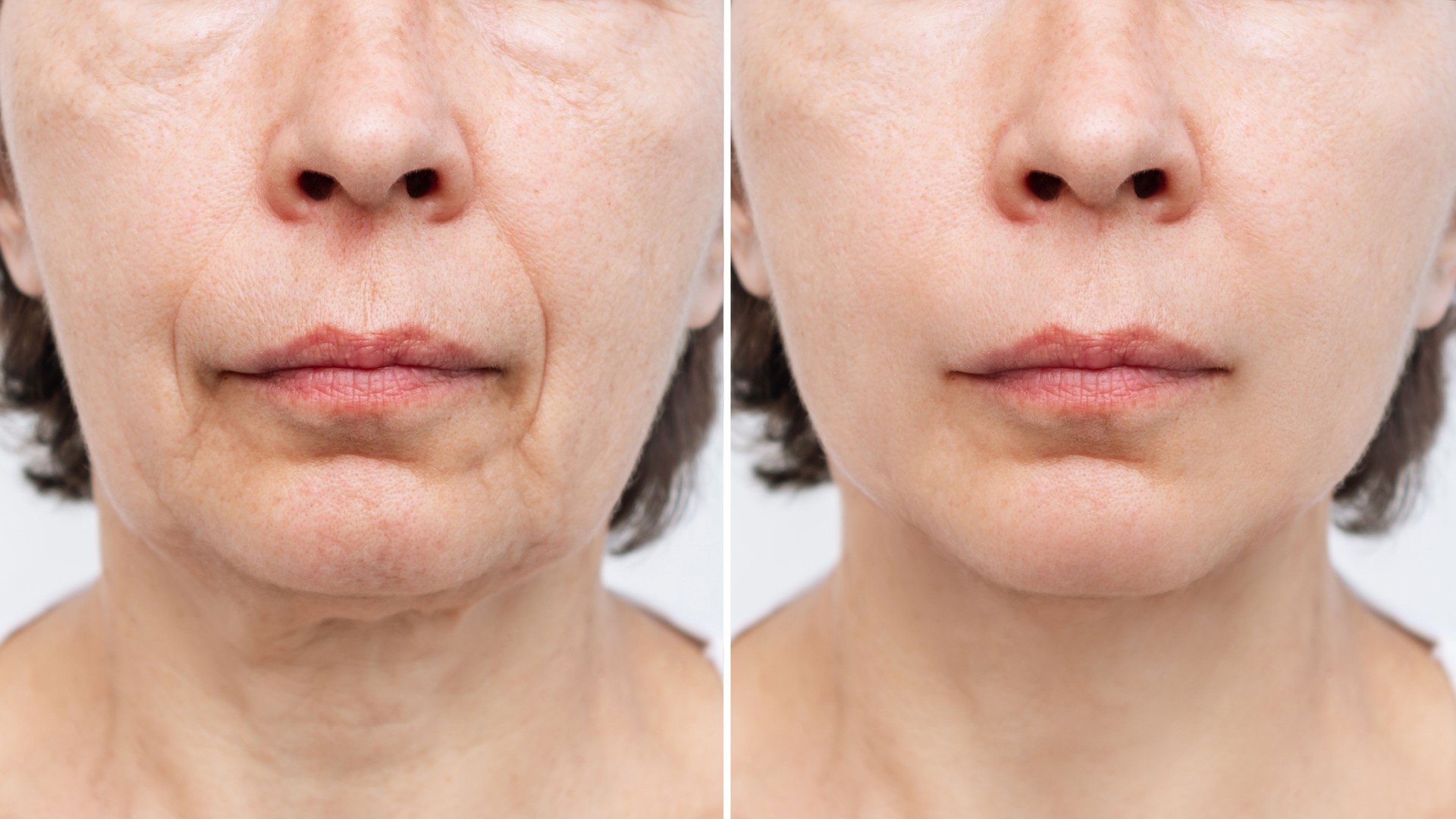 Lower part of face and neck of elderly woman with signs of skin aging before after facelift, plastic surgery