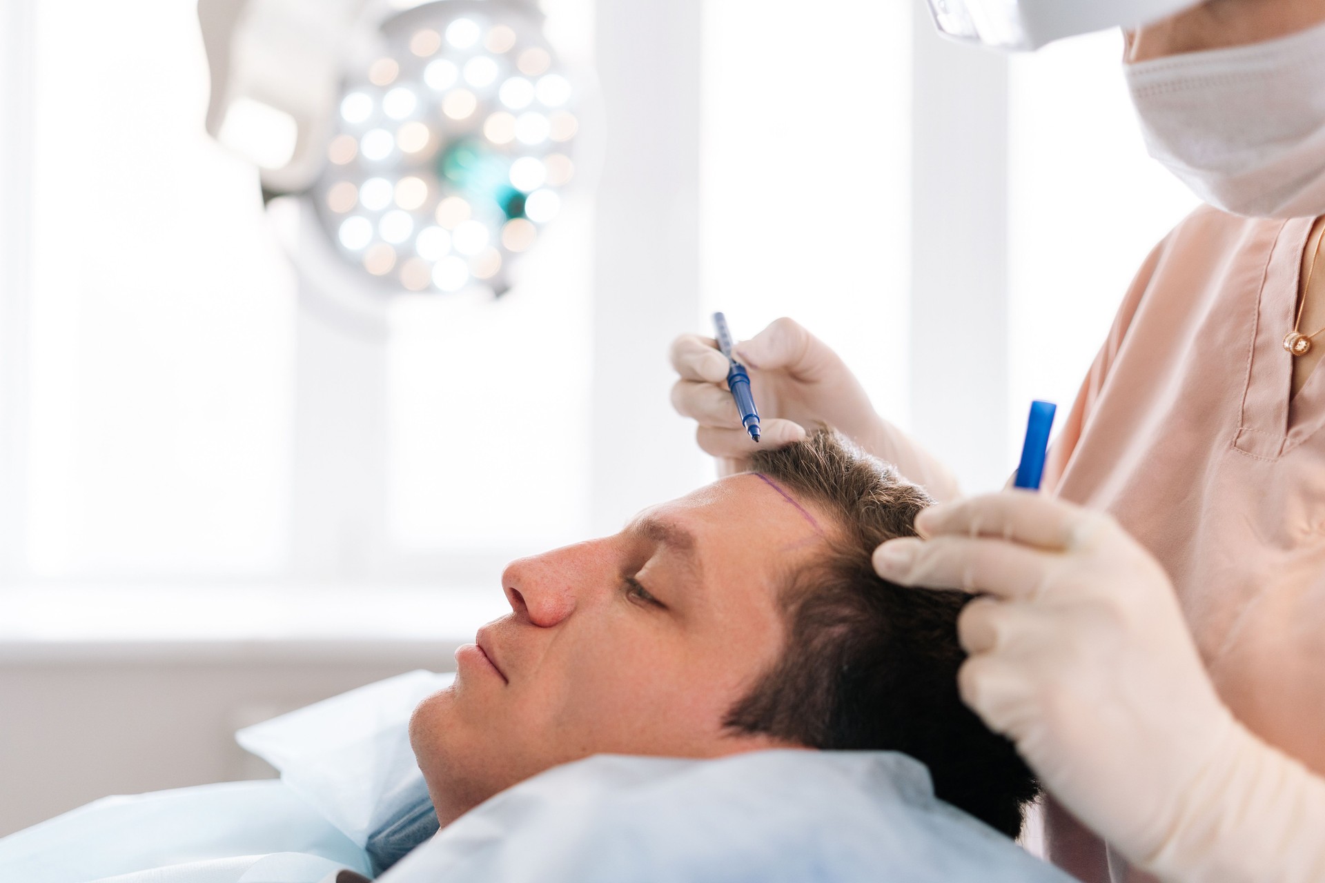 Closeup side view of unrecognizable female nurse drawing using pencil new hairline on head of patient male before hair transplantation surgery in clinic.