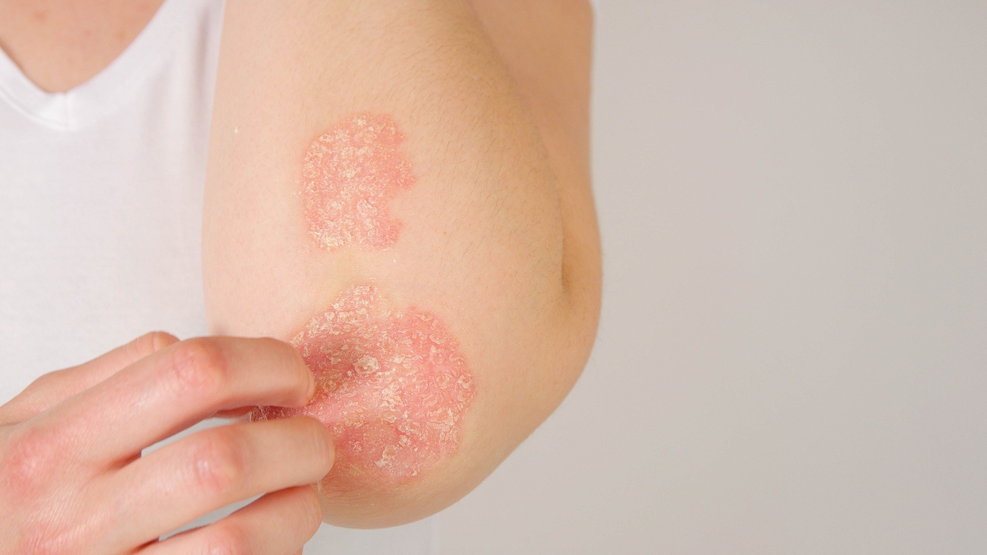 CLOSE UP: Unrecognizable female patient suffering from psoriasis skin disease
