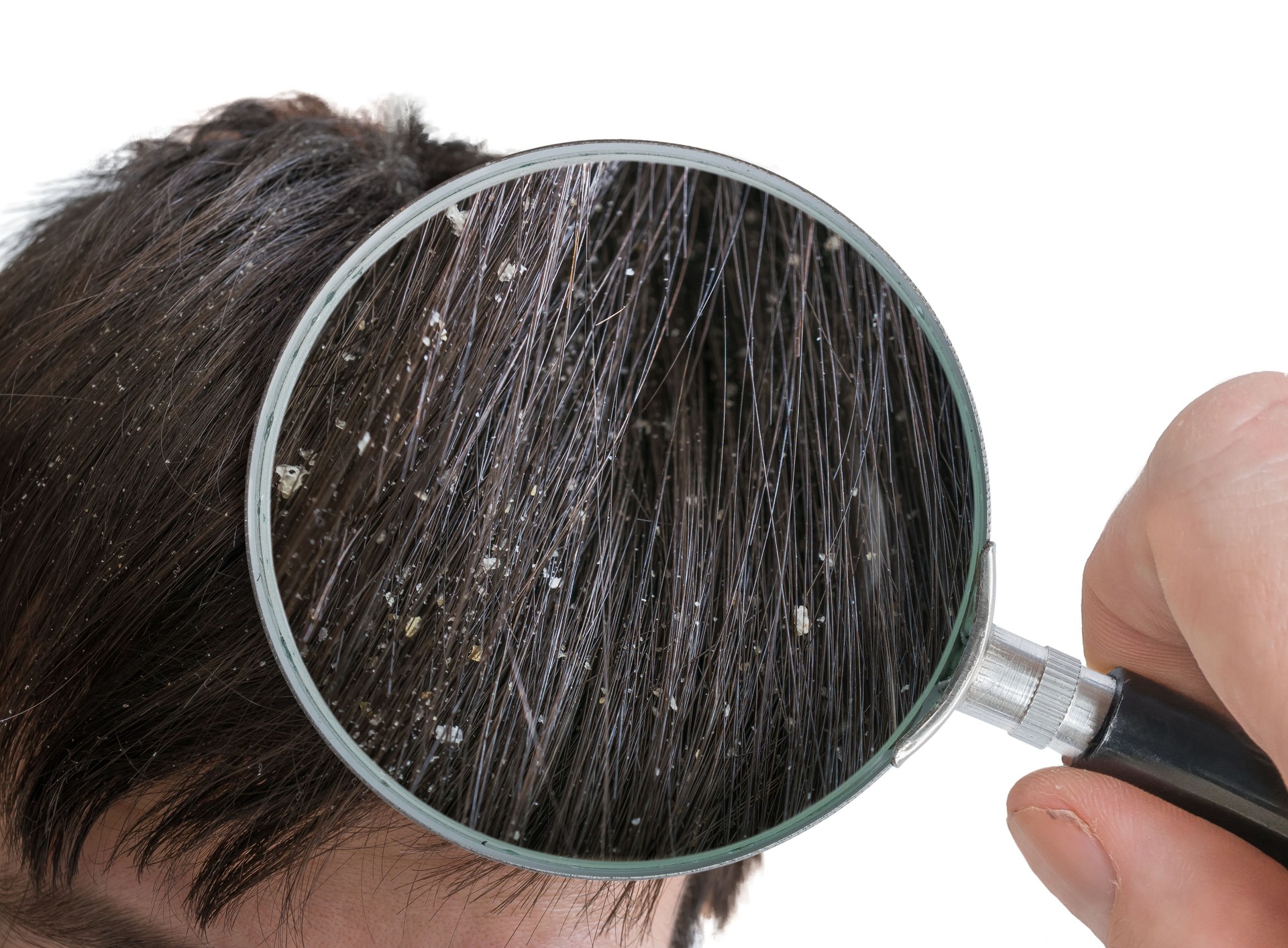 Examiming white dandruff flakes in hair with magnifying glass.